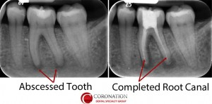 xray showing infection below tooth